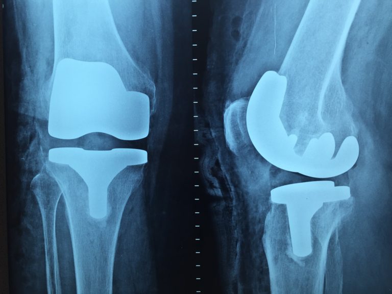 Najlepszą diagnozą jest artroskopia kolana.